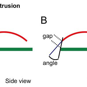 Gap protrusion